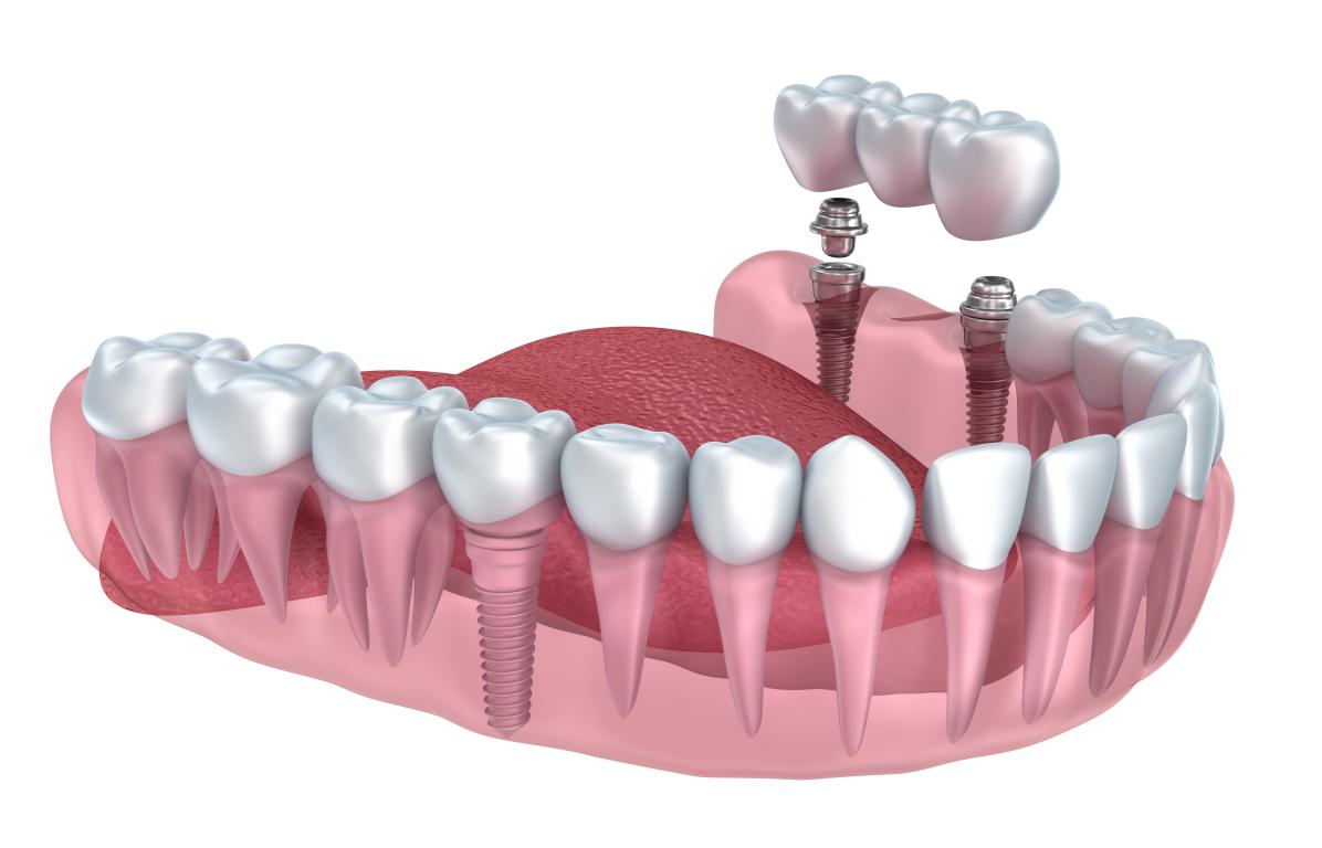 Implant dentaire : Une dent appréciée ?